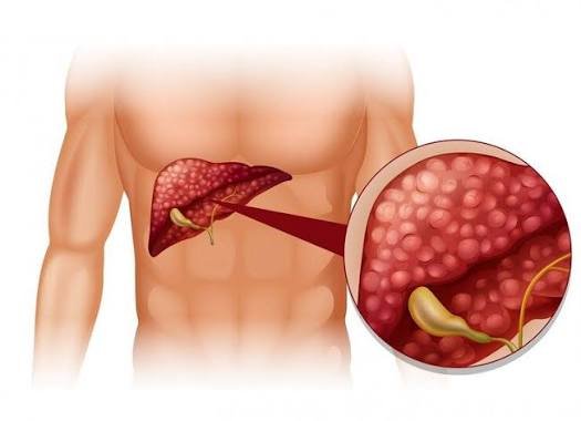 Liver Cancer Treatment