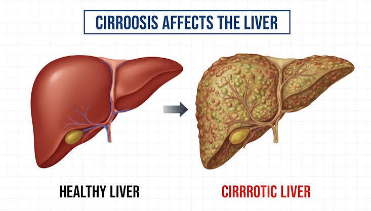 Managing Cirrhosis