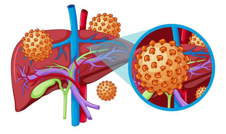 Hepatitis Symptoms
